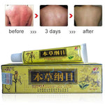 Advanced Psoriasis & Eczema Natural Chinese Herbal Cream