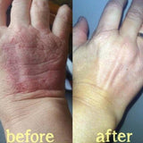 Advanced Psoriasis & Eczema Natural Chinese Herbal Cream