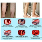 Vascular Varicose Veins Ointment