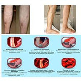 Vascular Varicose Veins Ointment